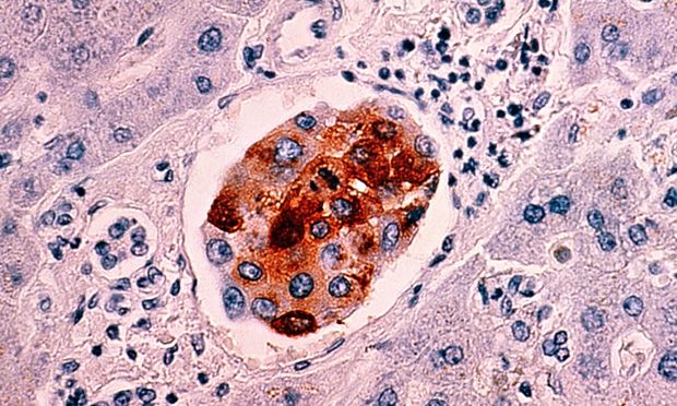 breast cancer cells